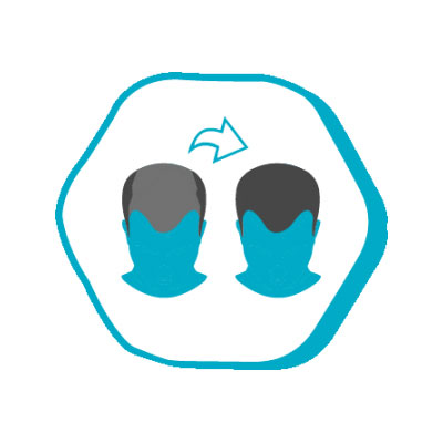 j4 j4 Efter hårtransplantation Istanbul Hair DK Prices in Turkey